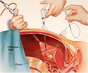 laparoskopik-cerrahinin-avantajlari